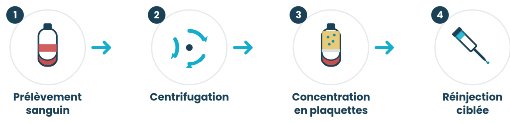 Les 4 étapes de préparation du PRP : prélèvement sanguin, centrifugation, concentration en plaquettes, réinjection ciblée